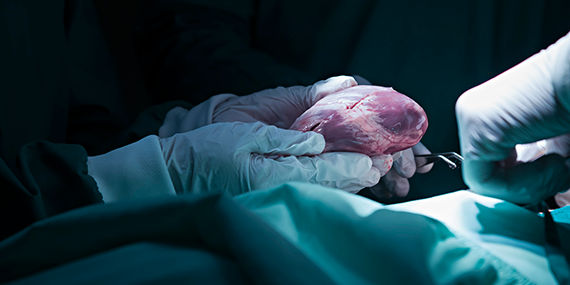 A surgeon holds a heart for transplant in an operating room