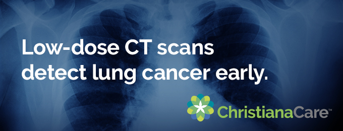 Low-dose CT scans detect lung cancer early