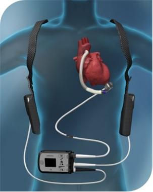 Left Ventricular Assist Device (LVAD)