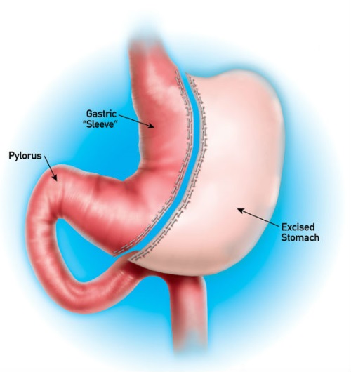 Illustration of a gastric sleeve
