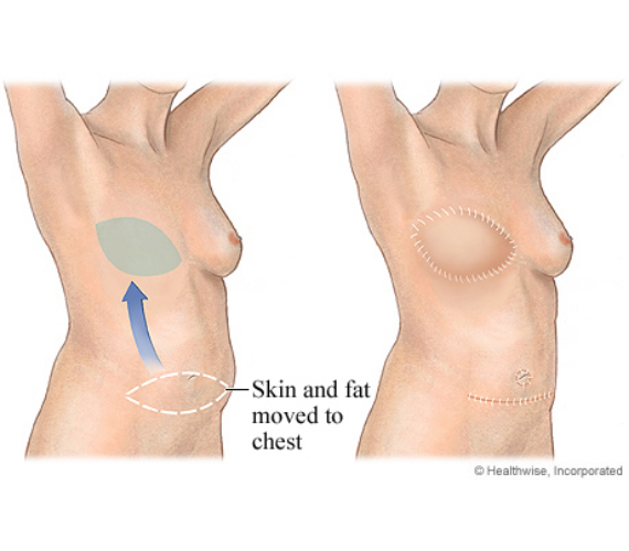 Where Are Incisions Made In A DIEP Flap Breast Reconstruction? - Ellsworth  Plastic Surgery