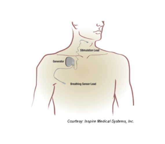 Upper airway stimulation diagram
