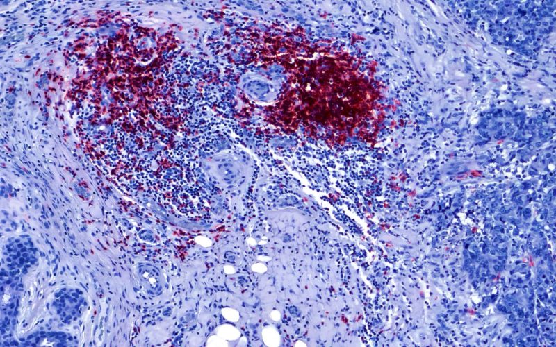Células teñidas de rojo, células tumorales teñidas de azul oscuro