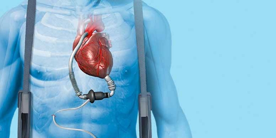 Left Ventricular Assist Device attached to the heart