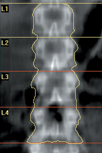 Bone Density Scan
