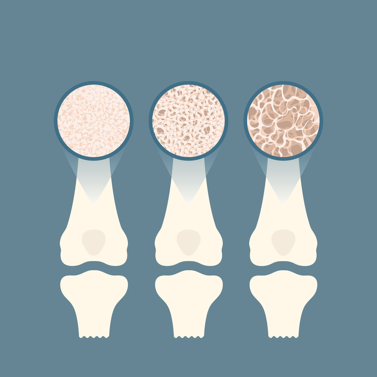 Osteoporosis, conceptual illustration.