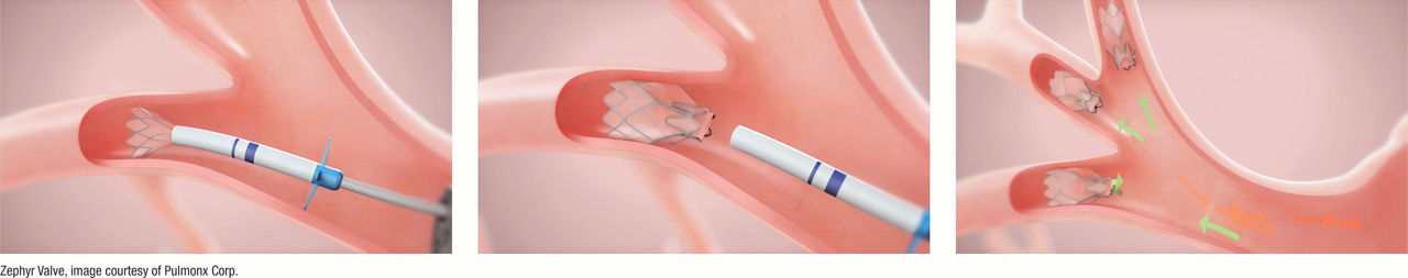 Lung Valves Final Med