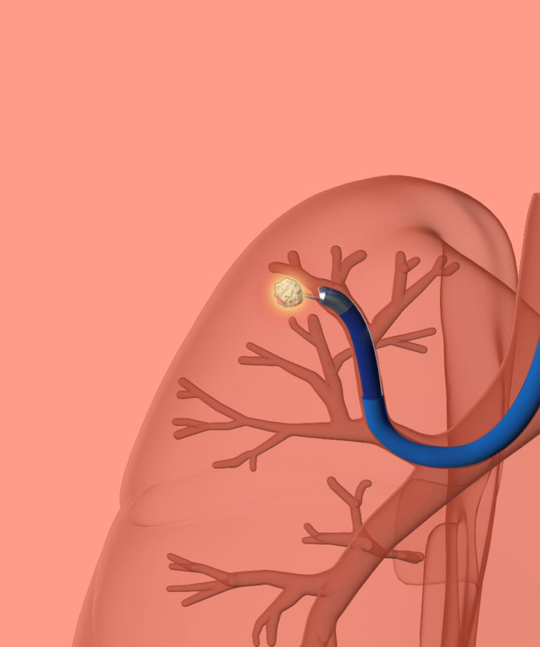 An illustration of a needle biopsy of a lung nodule