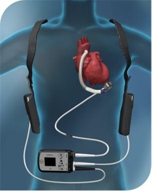 A diagram showing how an LVAD unit is used