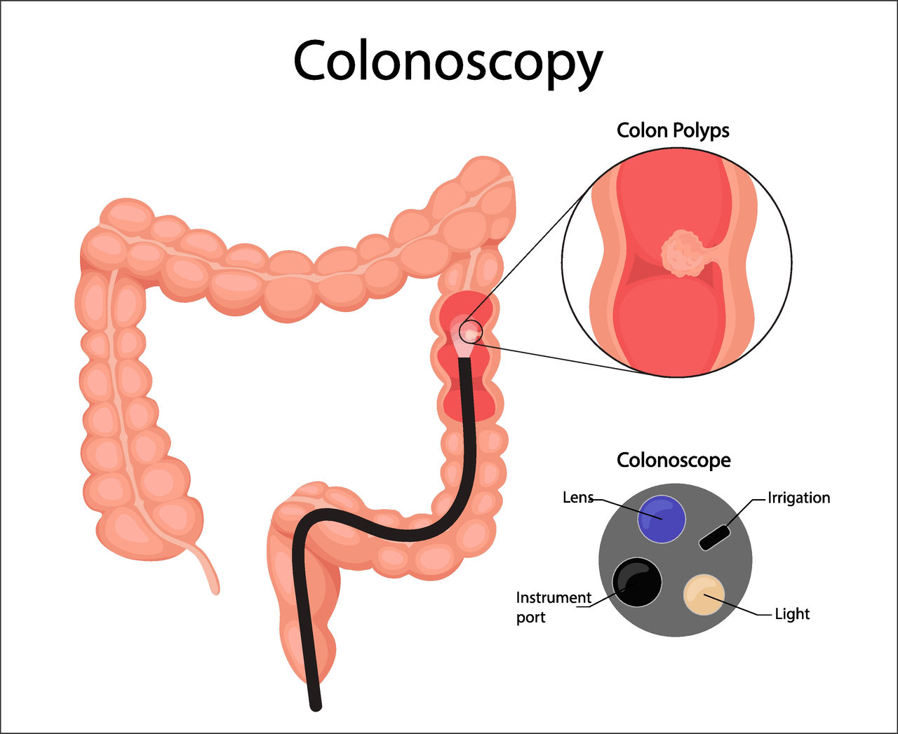 Human bladder cancer. malignant cells concept. Vector in cartoon style