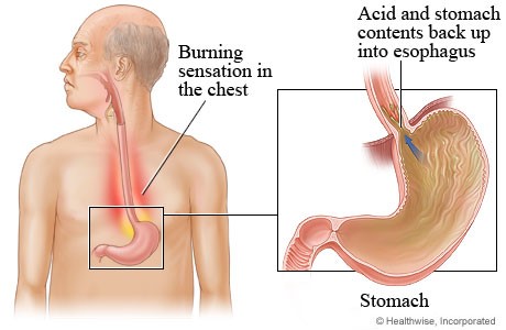 Artwork explaining acid reflux