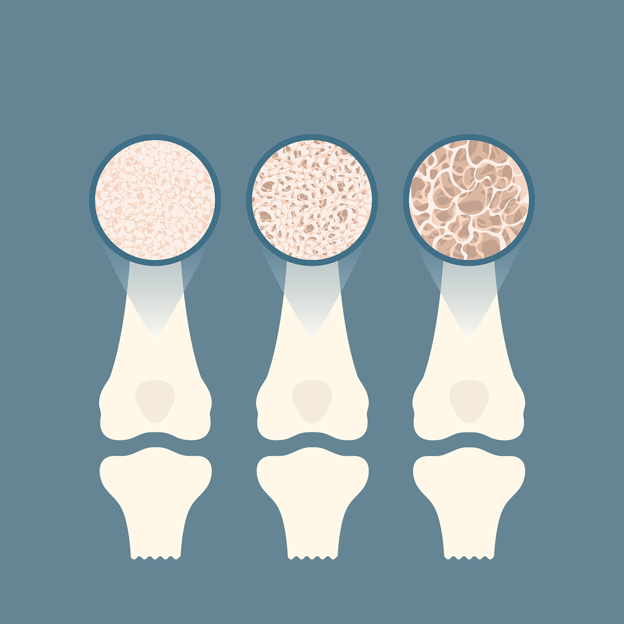 Un diagrama que muestra células de diferentes niveles de salud ósea