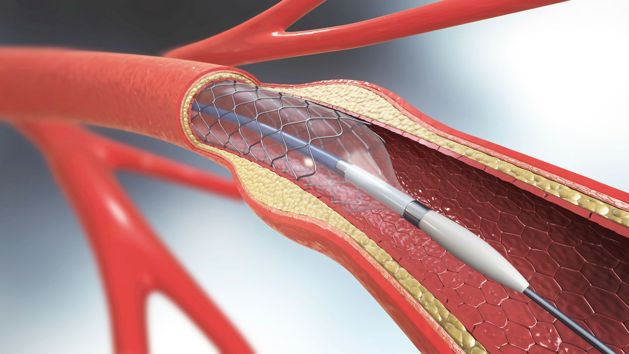 Ilustración de un stent arterial