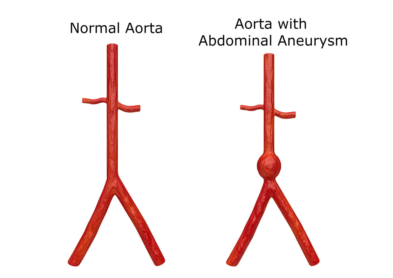 Vista interna del cuerpo humano que muestra una aorta normal y un aneurisma aórtico en la región torácica y abdominal.