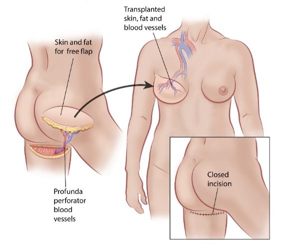 Digram of pap flap procedure